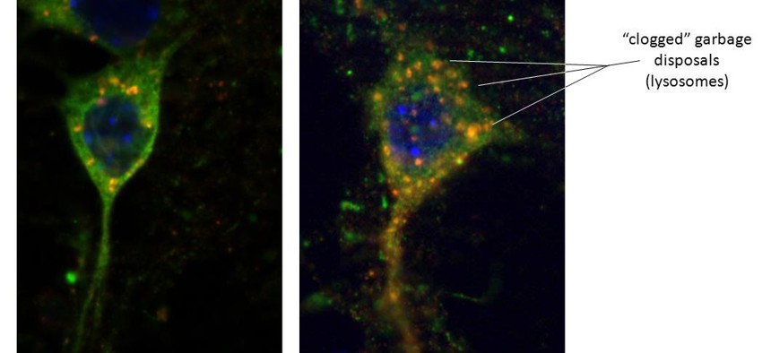 Left - Healthy neuron with alpha-synuclein (green) protein. Red dots are trash lysosomes with alpha-synuclein entering, hence an orange hue. Right - Sick neuron from LRRK2 brain. Lysosomes are enlarged as the alpha-synuclein is unable to enter the trash.