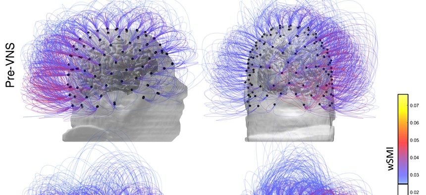 This image provided by the CNRS Marc Jeannerod Institute of Cognitive Science in Lyon, France, shows brain activity in a patient before, top row, and after vagus nerve stimulation. Warmer colors indicate an increase of connectivity.