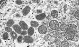 Electron microscope image of various virions (virus particles) of the monkeypox virus taken from human skin in 2003.