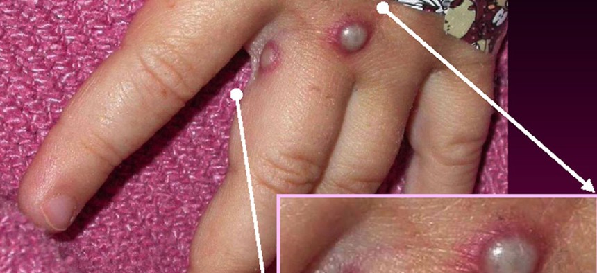 A Centers for Disease Control and Prevention handout graphic shows symptoms of the monkeypox virus on a patient’s hand on May 27, 2003. 